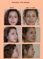 Rinoplasty1.jpg